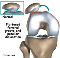 recurrent knee dislocation